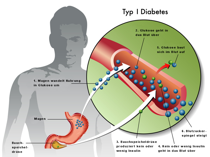 Diabetes Ursachen Symptome Und Arten Der Zuckerkrankheit